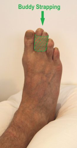 Person with their injured toe buddy strapped to a non injured toe