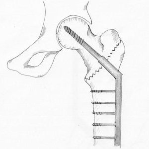 Illustration showing a dynamic hip screw device
