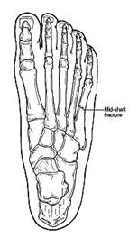Diagram of the human foot showing a mid-shaft bone fracture