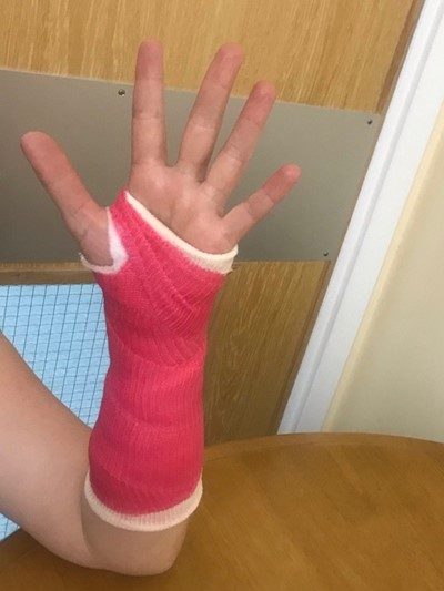 Person wearing a plaster cast with their hand open fully