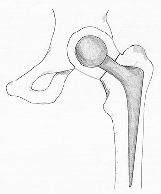Illustration showing replacement of half of the hip joint known as a hemiarthroplasty