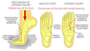 Illustration showing a healthy foot and a Lisfranc injury