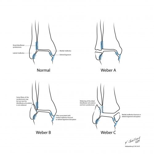Diagram of Weber A, B and C fractures compared to an uninjured ankle