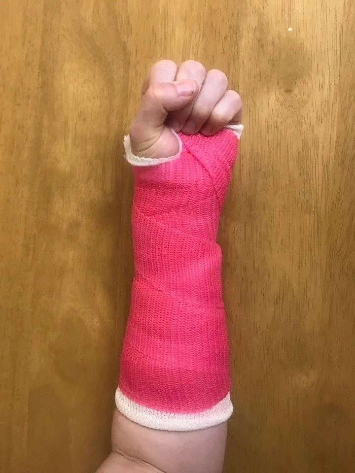 Person wearing a cast and making a fist, with their thumb on top of their other fingers